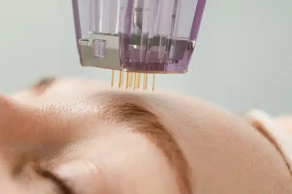 Toronto Microneedling Treatment image