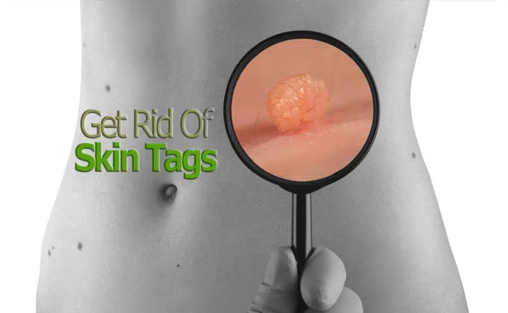 Skin Tag Removal Small