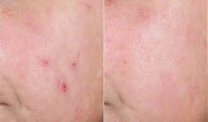 before and after acne treatment