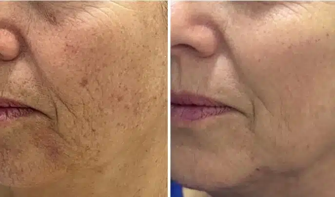 before and after laser treatment