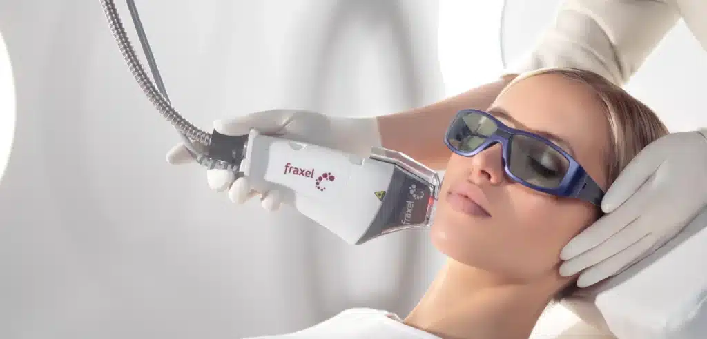 Toronto fraxel treatment on woman