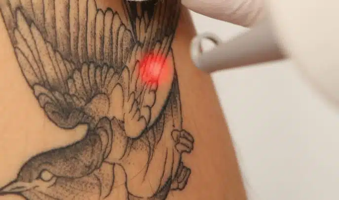 Tattoo Removal 1″ x 1″ Area pkgs
