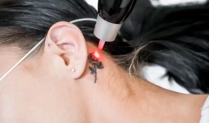 Tattoo Removal 3″ x 3″ Area pkgs