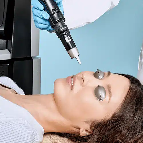 picosure laser spot removal treatment toronto