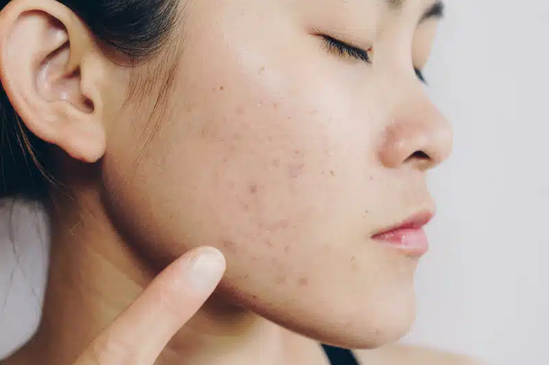 Best Clinical Treatments for Acne Scars in Toronto