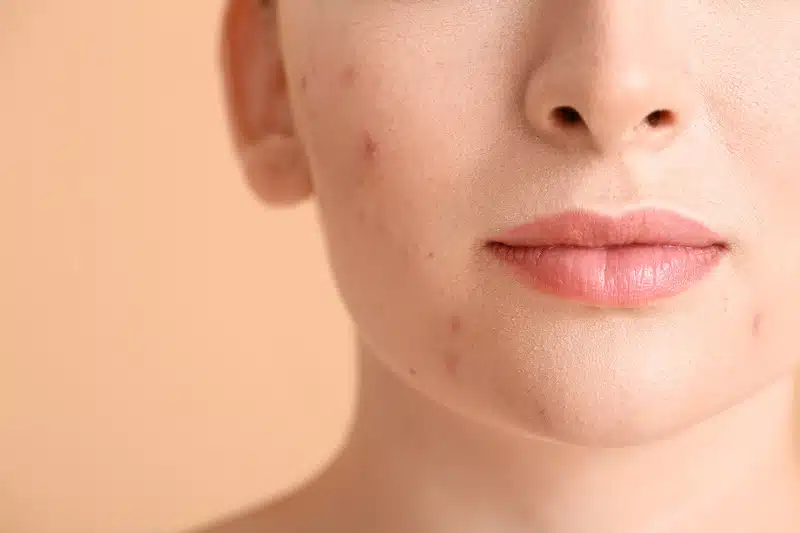 First Visit to a Toronto Acne Clinic: What to Expect
