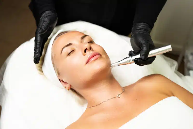 Fraxel Laser vs Microneedling for Acne Scars