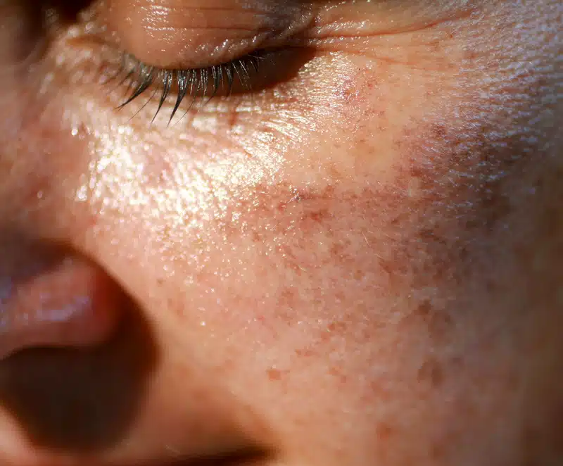Hyperpigmentation & Sun Damage Treatments in Toronto