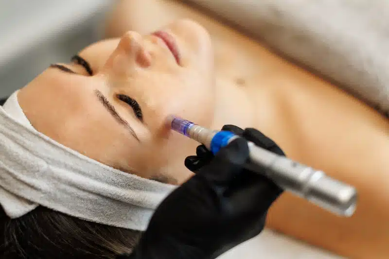 RF Microneedling for Skin Texture & Firmness