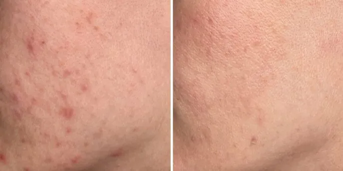 Before and after Acne Scar Removal, photo 1
