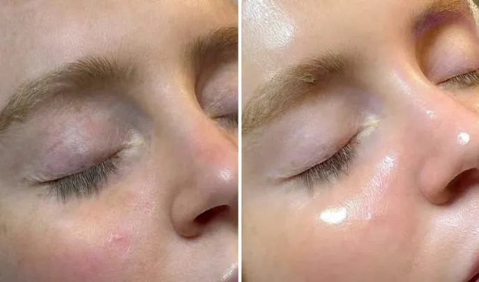 Before and after Hydrafacial, photo 2