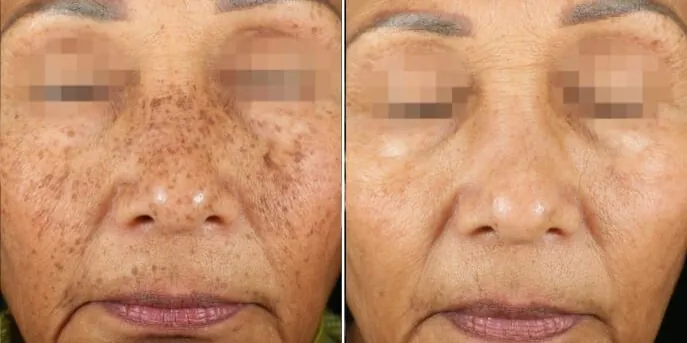 Before and after PicoSure Spot Removal, photo 1