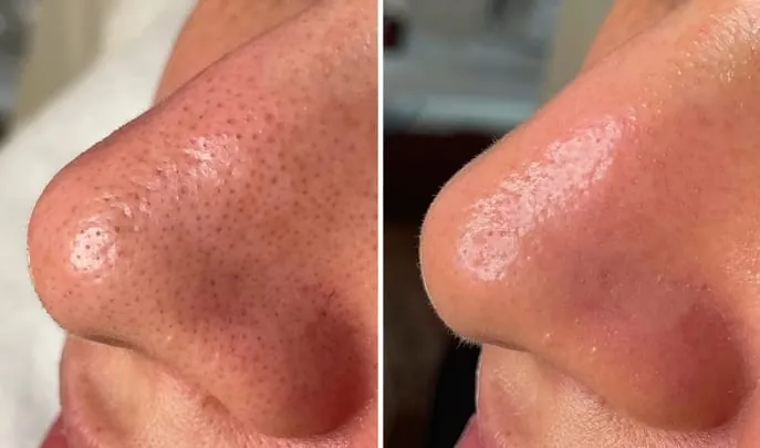 Before and after Hydrafacial, photo 3