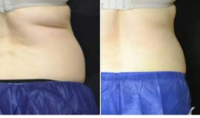 Before and after CoolSculpting, photo 3