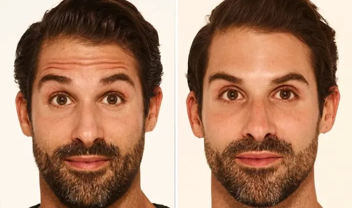 Before and after Botox & Dysport, photo 1