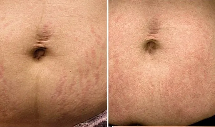Before and after Laser Stretch Mark Removal, photo 1