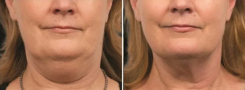 Before and after CoolSculpting for Double Chin, photo 1