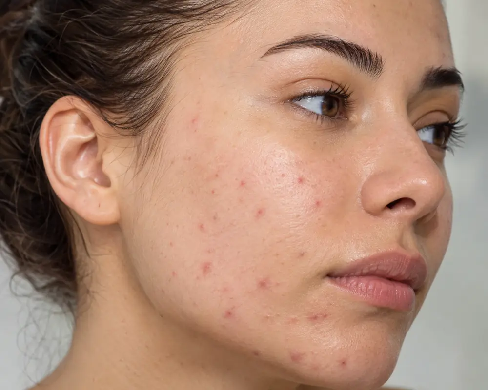 Acne Treatments