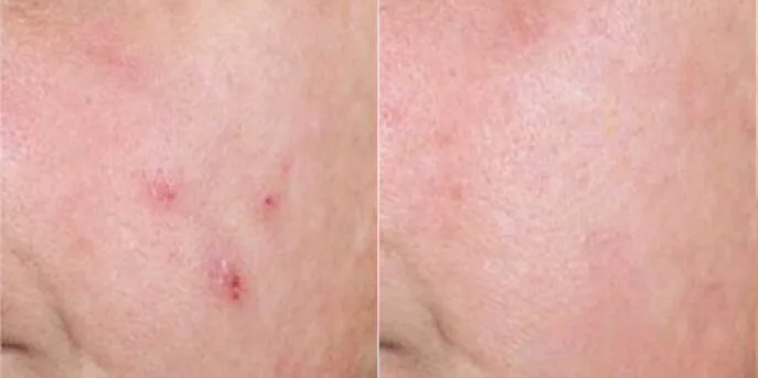 Before and after Acne Injections, photo 2