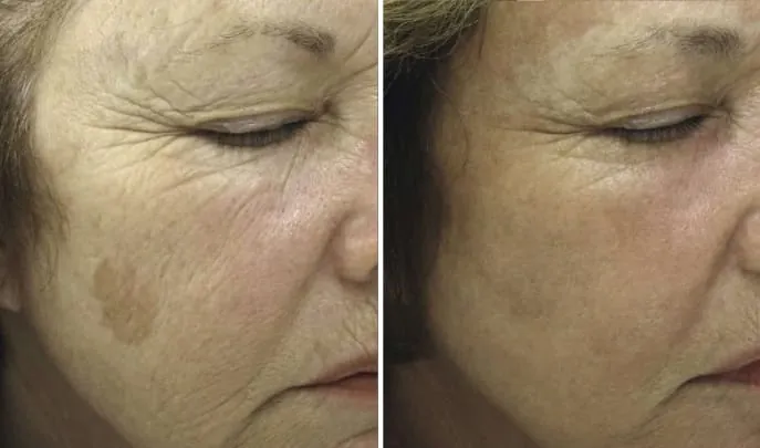 Before and after Fraxel Laser Resurfacing, photo 2