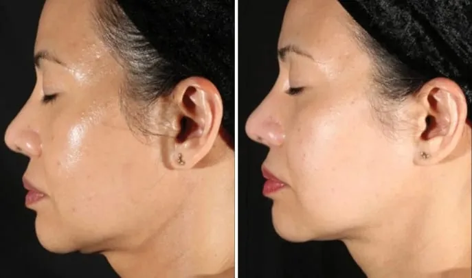Before and after XERF Skin Tightening, photo 3