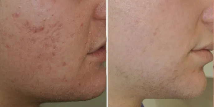 Before and after Scar Removal, photo 1