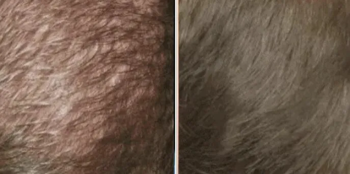 Before and after Laser Hair Loss Treatment, photo 1