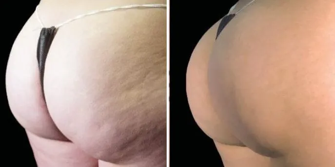 Before and after Emsculpt Neo, photo 1