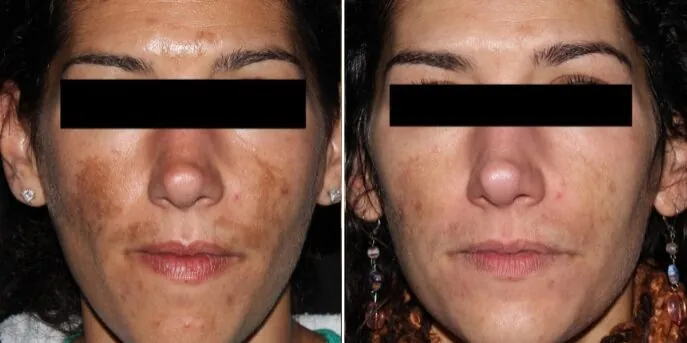 Before and after Pigmentation Treatments, photo 3