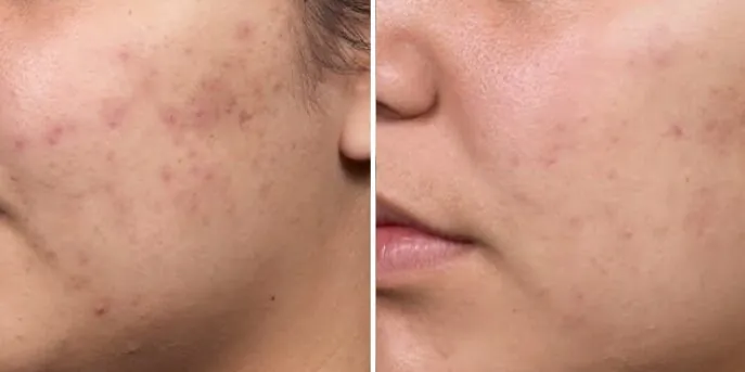 Before and after Acne Scar Removal, photo 2