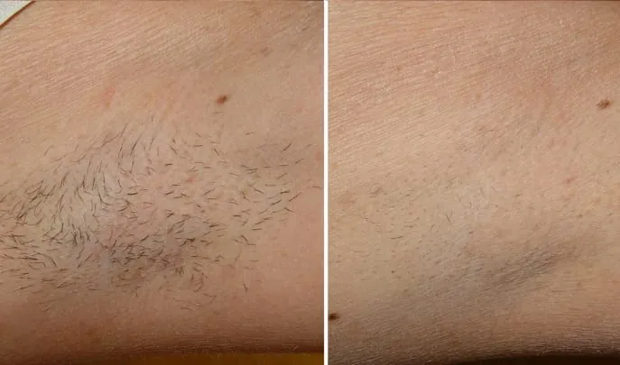 Before and after laser hair removal, photo 1