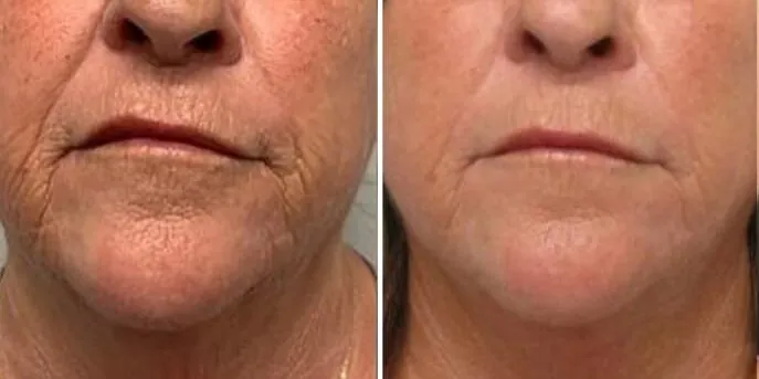 Before and after Microneedling, photo 1