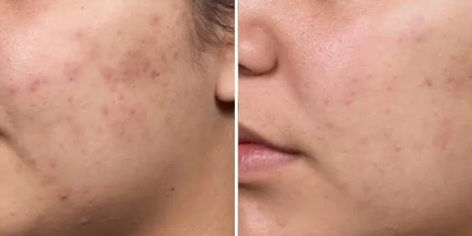 Before and after Acne Treatments, photo 2