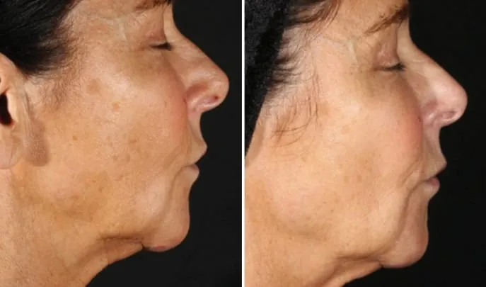 Before and after XERF Skin Tightening, photo 2