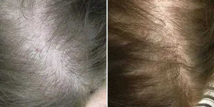 Before and after Laser Hair Loss Treatment, photo 3