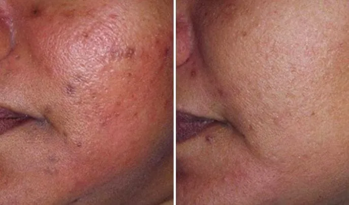 Before and after Laser Genesis, photo 1