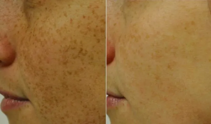 Before and after IPL Photorejuvenation, photo 1