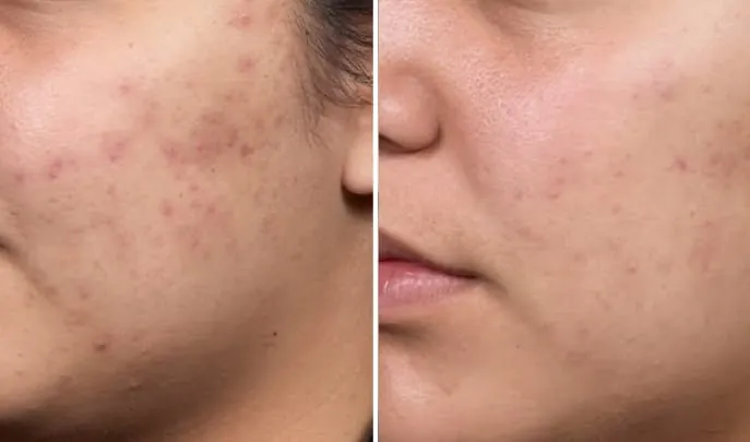 Before and after Chemical Peels, photo 1