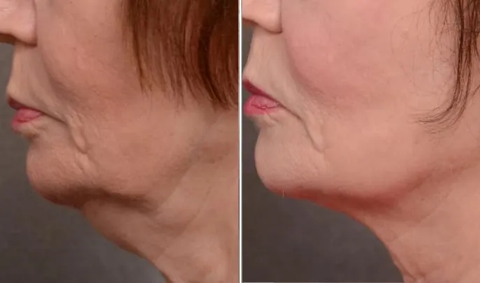 Before and after Forma Skin Tightening, photo 1