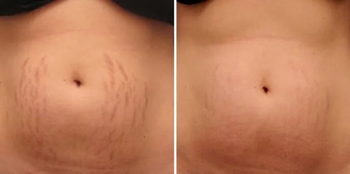 Before and after Stretch Mark Treatments, photo 2