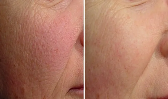 Before and after Laser Genesis, photo 2