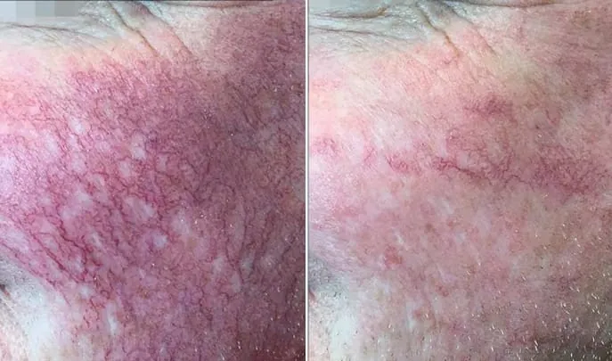 Before and after Laser Spider Vein Removal, photo 3