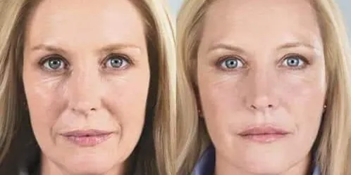 Before and after Sculptra, photo 2