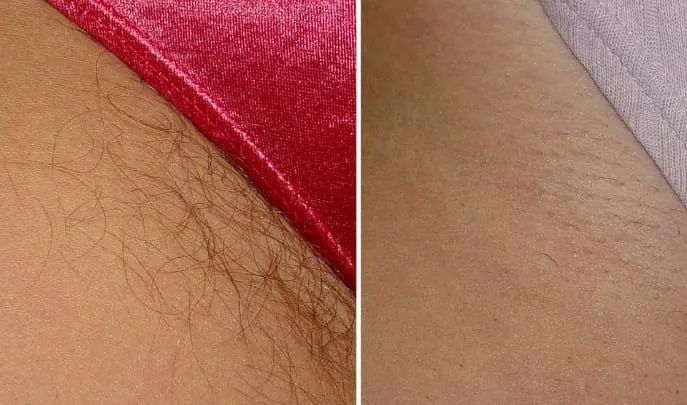 Before and after laser hair removal, photo 2
