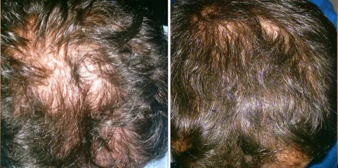 Before and after Liquid Formula Hair Restoration, photo 3