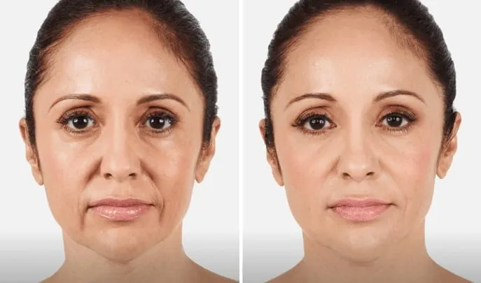 Before and after Dermal Fillers, photo 1