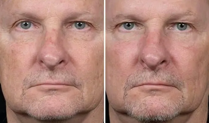 Before and after Fraxel Laser Resurfacing, photo 3