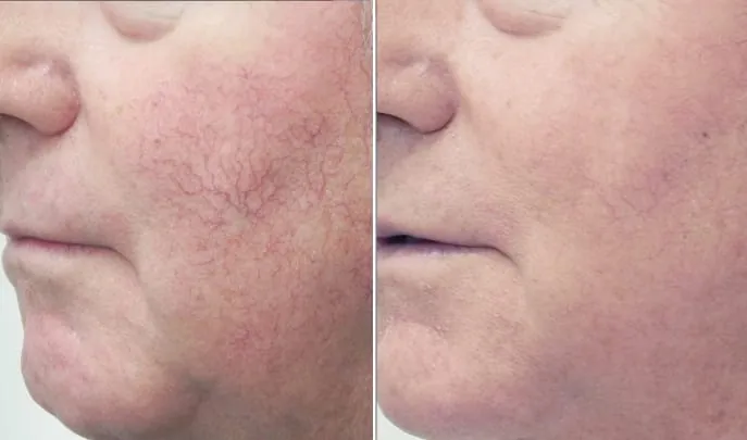 Before and after Laser Spider Vein Removal, photo 2