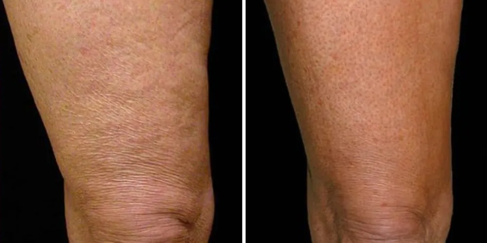 Before and after Thermage for Cellulite, photo 2