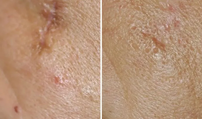 Before and after Carboxytherapy for Scars, photo 1